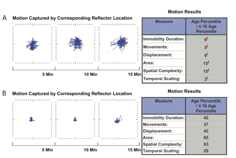 Harvard-Studie unterstützt Sensorik- und Motoriktraining bei ADHS